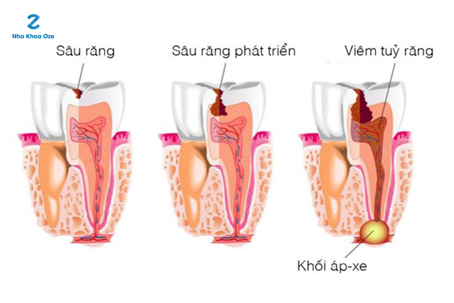 Dentanalgi có tác dụng giảm đau răng lâu dài không?