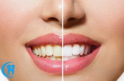 Phương pháp lấy cao răng giúp mang lại một hàm răng trắng sáng