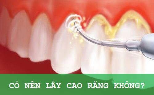Lấy cao răng giúp loại bỏ những mảng bám ố vàng cứng đầu