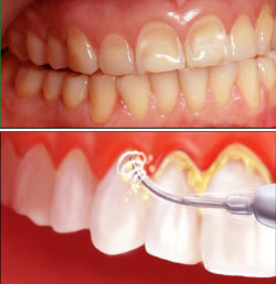 Việc lấy cao răng tại nhà cần phải thực hiện đúng kỹ thuật