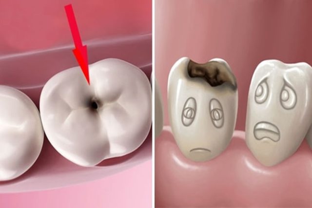 Tình trạng răng bị sâu