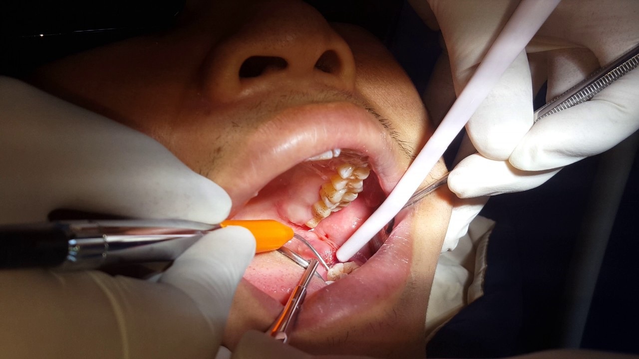 triệu chứng sau khi lấy tuỷ răng 2