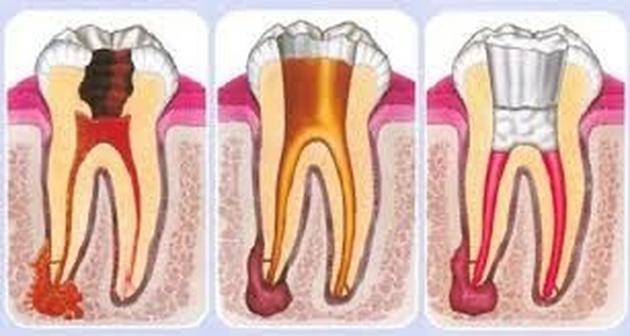 triệu chứng sau khi lấy tuỷ răng 3