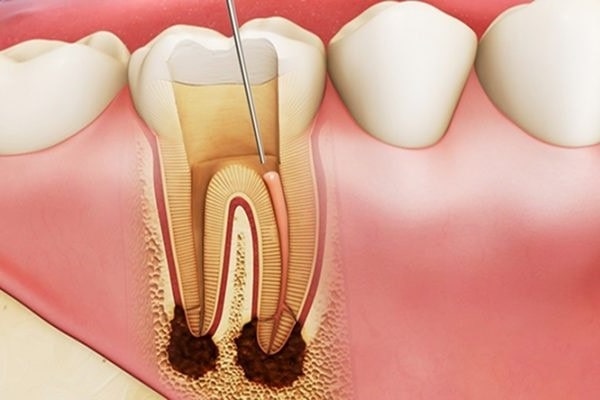 Tuỷ răng là gì?