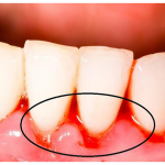 Cách giải quyết hiện tượng chảy máu chân răng