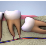 Răng khôn mọc lệch