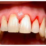 Những vấn đề mà ai cũng cần phải biết khi mắc chứng bệnh viêm lợi
