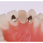 Cầu răng sứ có cánh dán được dùng với vùng răng trước