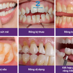 Các trường hợp nên làm răng sứ thẩm mỹ