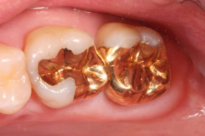 Vật liệu trám răng bằng vàng