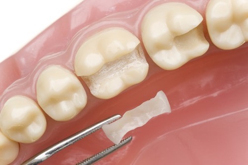 Vật liệu trám răng Composite được lựa chọn nhiều nhất