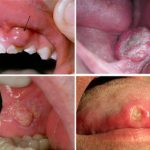 Dấu hiệu ung thư răng