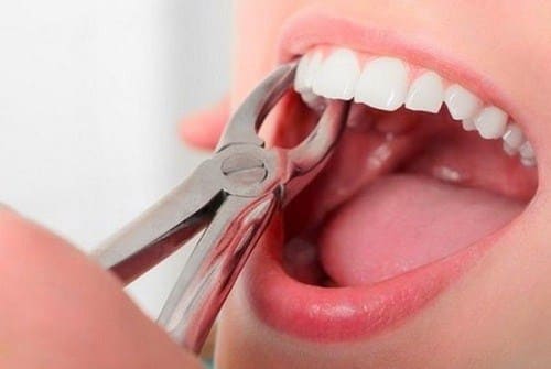 Răng khôn mọc lệch gây ra sâu răng và đau đớn cho bệnh nhân