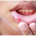 Ảnh minh họa vết loét do nhiệt miệng