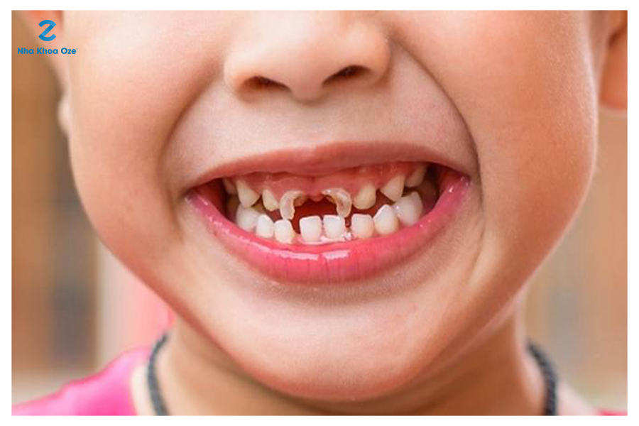 Sún răng là bệnh lý răng miệng ở trẻ rất dễ mắc phải