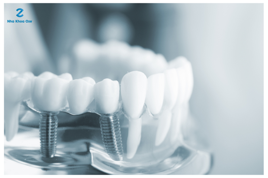 Trồng răng implant thay thế cấu trúc của răng thật