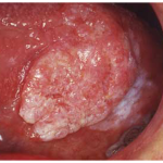 Ảnh minh họa vết loét ung thư miệng