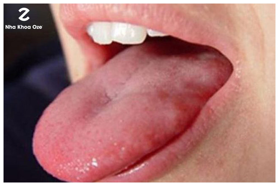 Các nguyên nhân gây ra nhiệt miệng nổi mụn ở lưỡi là gì?

