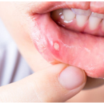 Lở miệng là gì? Cần điều trị như thế nào cho hiệu quả?