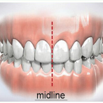Khớp cắn chính là mối tương quan giữa hàm trên và hàm dưới
