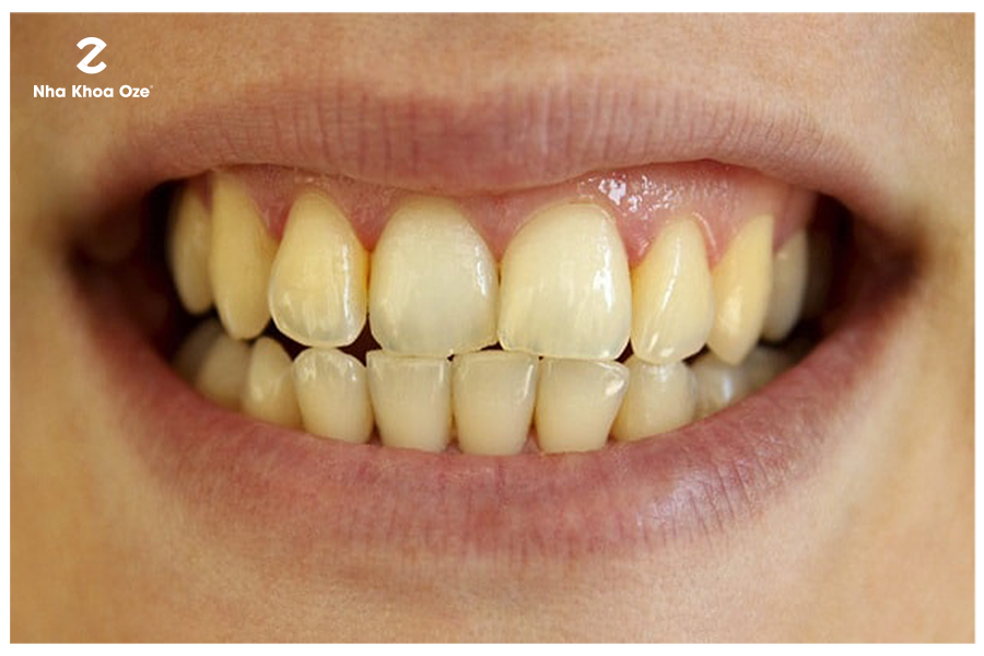 Những điều cần biết về răng vàng, nguyên nhân và cách giải quyết