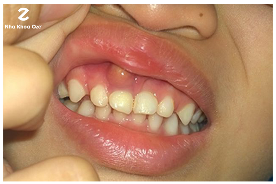 Viêm quanh răng gây ra các biến chứng áp xe răng