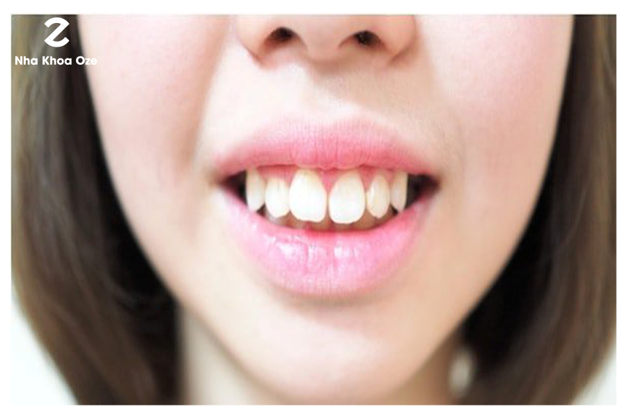 Răng hô gây mất thẩm mỹ và ảnh hưởng đến chức năng nhai cắn