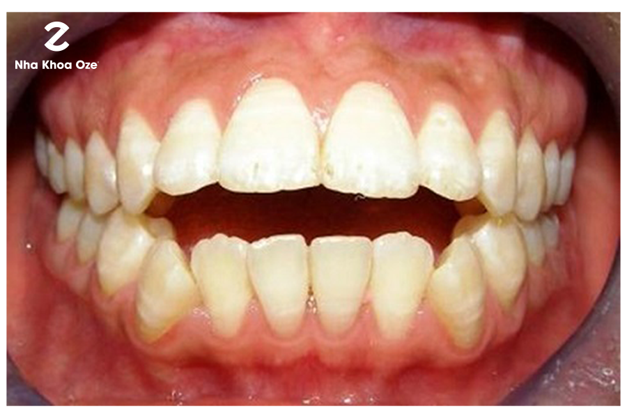Vẩu cả răng và hàm là nặng nhất, cần được chữa trị kịp thời