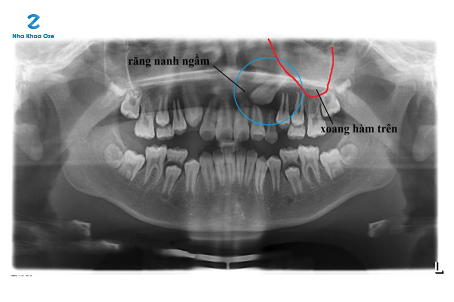Đặt trụ implant vào xương hàm vùng mất răng
