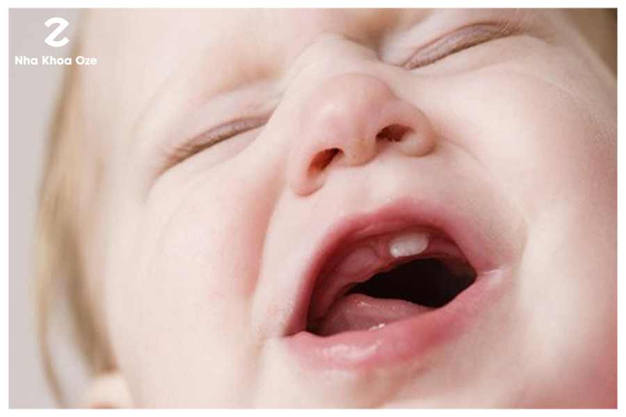 Những nguyên nhân nào có thể khiến trẻ mọc răng chậm