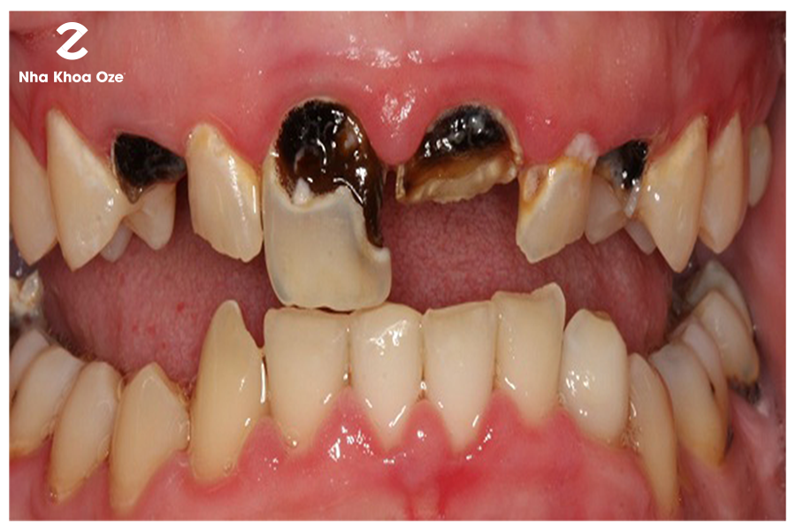 Sún răng sẽ ảnh hưởng đến việc mọc răng vĩnh viễn sau này