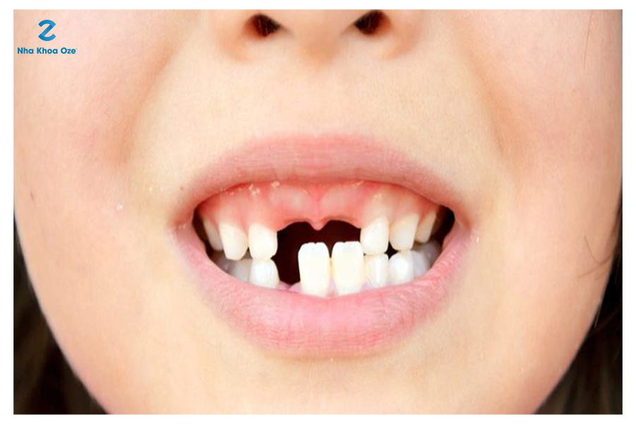 Có rất nhiều nguyên nhân gây nên tình trạng sún răng ở trẻ