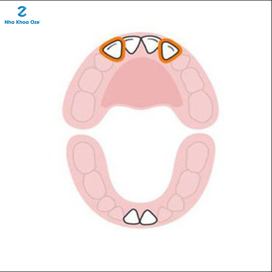 2 chiếc răng cửa số 2 ở hàm phía trên bắt đầu nhú mọc (khoảng 9 tháng tuổi)