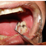 Những dấu hiệu nhận biết răng sâu vào tủy