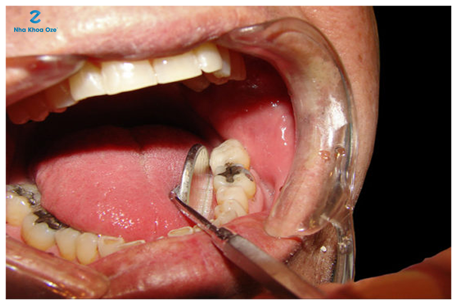 Những dấu hiệu nhận biết răng sâu vào tủy