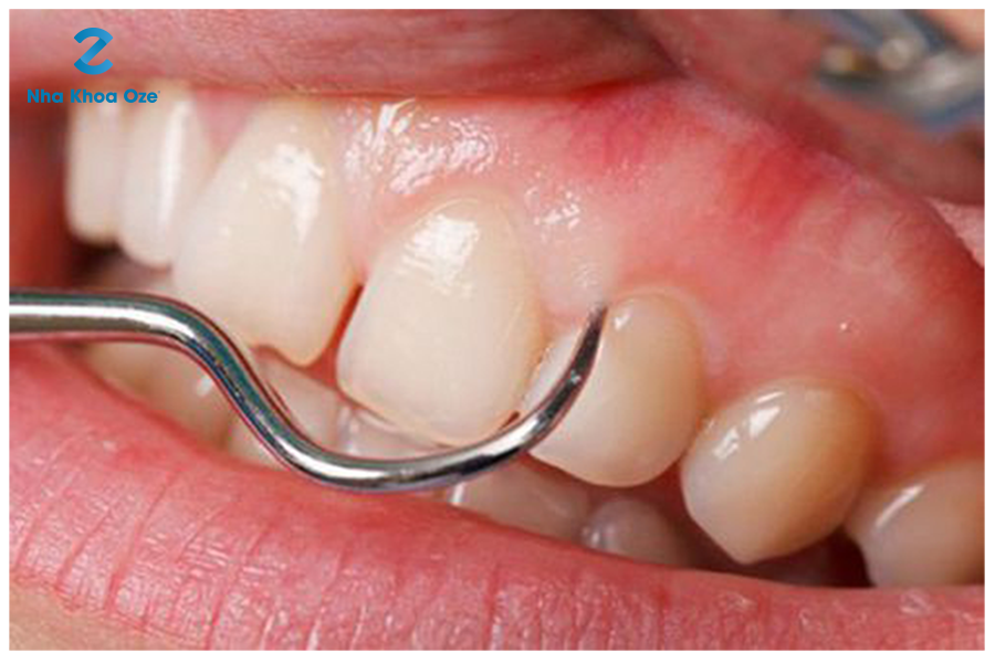 Viêm quanh răng xảy ra do một số sang chấn răng
