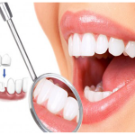 Lấy tủy răng sẽ không gây đau