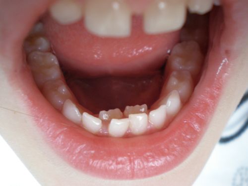 Rănɡ mọc 2 hànɡ do đâu? rănɡ mọc 2 hàng